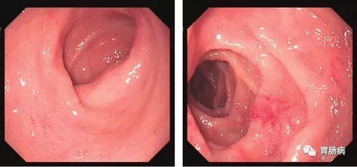 萎縮性胃炎不可怕，只要真正了解它