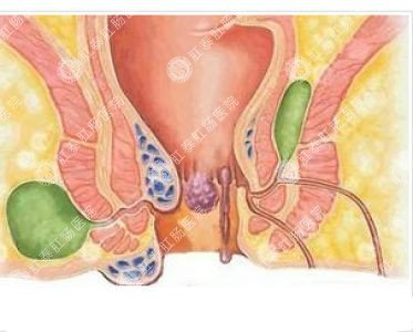 南寧哪個(gè)醫(yī)院可以做肛周膿腫？